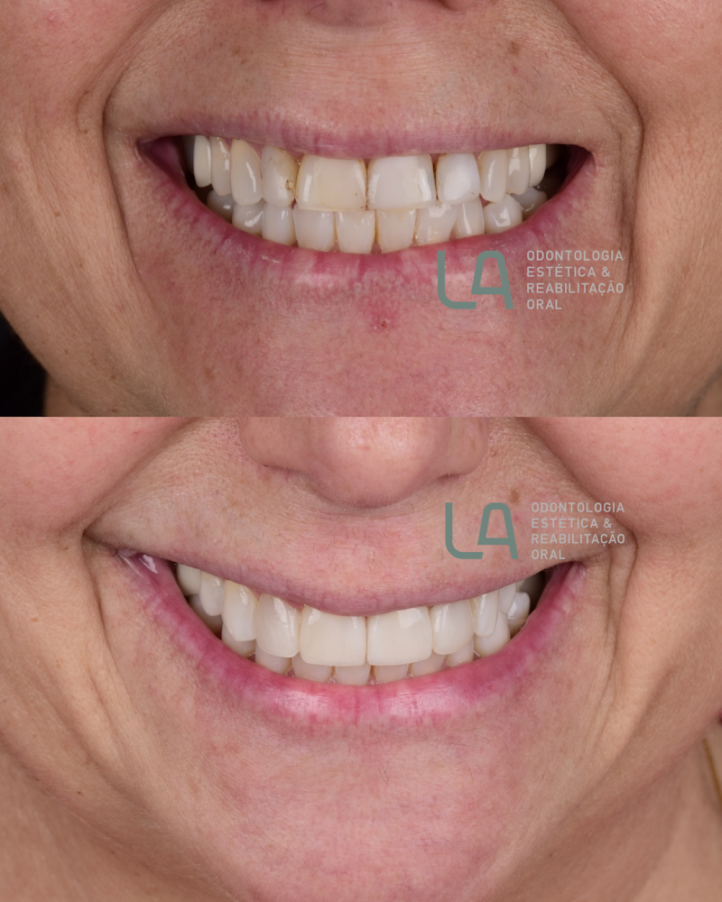 Dra. Larissa Araújo | Dentista Bela Vista | Facetas em resina | Facetas em porcelana - foto 5