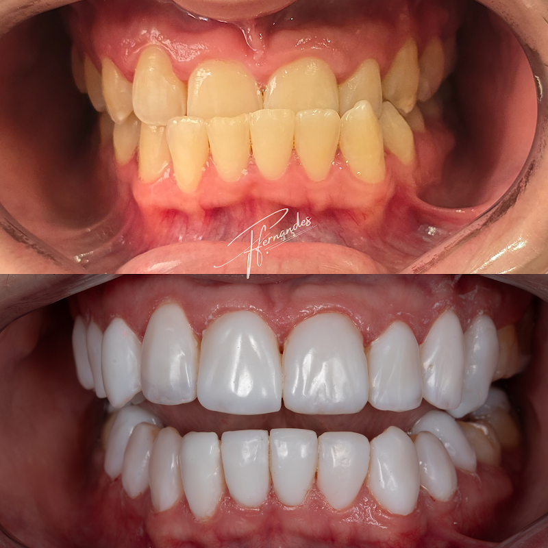 FACETAS EM RESINA E IMPLANTES DENTÁRIOS EM FLORIANÓPOLIS DRA. FERNANDA FERNANDES - foto 2