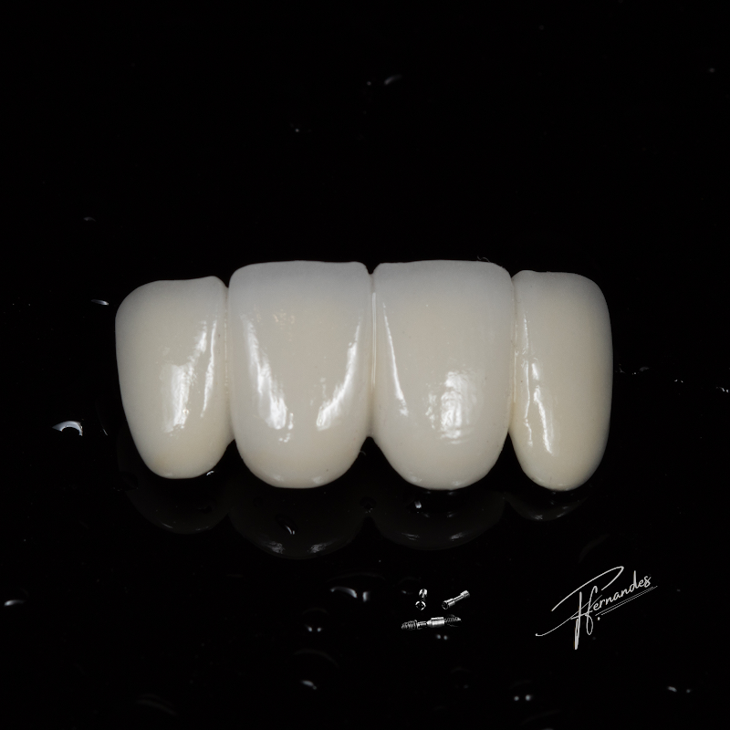 FACETAS EM RESINA E IMPLANTES DENTÁRIOS EM FLORIANÓPOLIS DRA. FERNANDA FERNANDES - foto 3