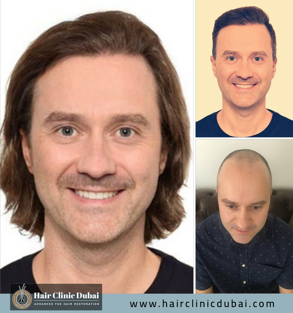 Hair Clinic Dubai 4