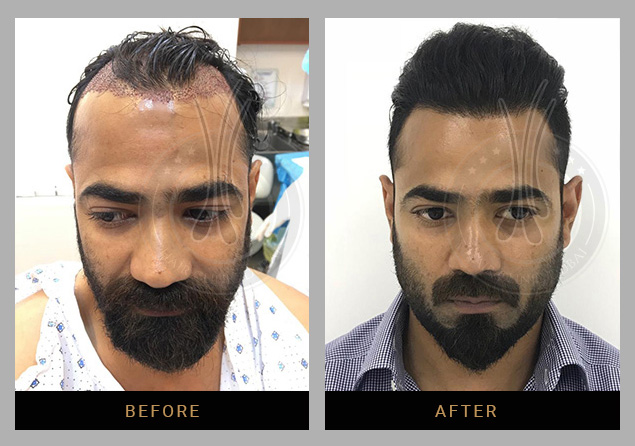 Hair Clinic Dubai 2