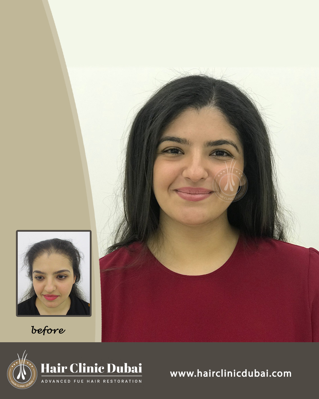 Hair Clinic Dubai 5
