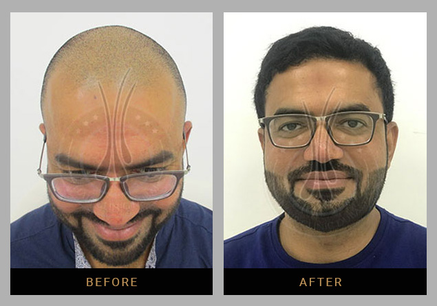 Hair Clinic Dubai 3