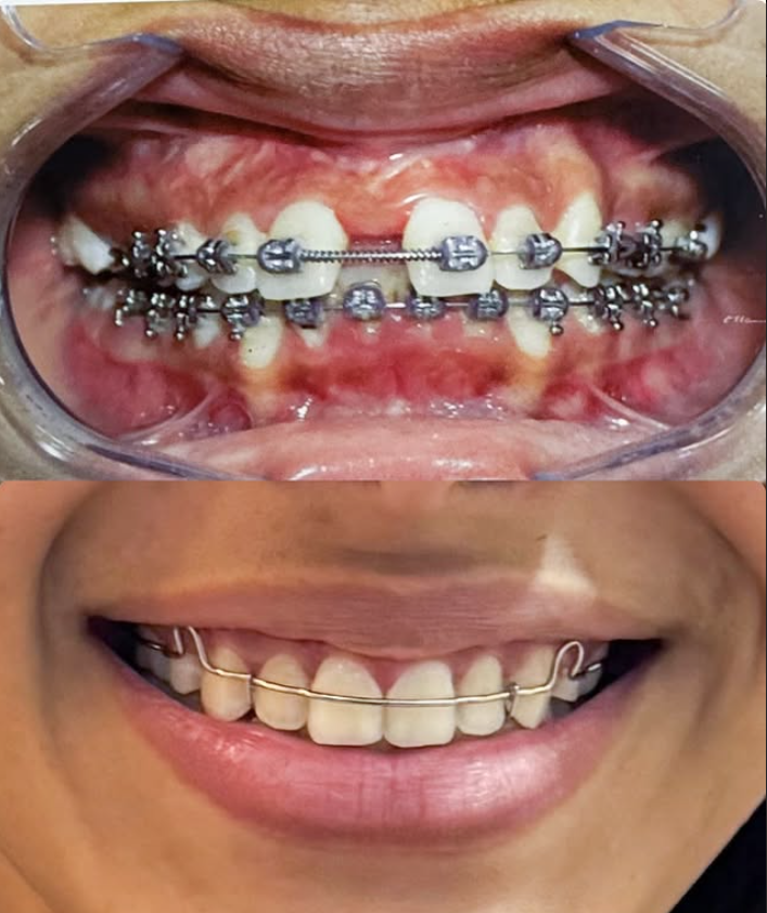 LS Odontologia - Implantes dentários em Angra dos Reis | Prótese Protocolo em Angra dos Reis - foto 3