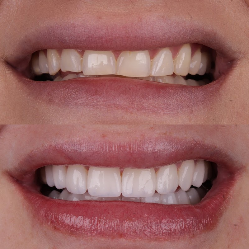 Smillens | Lentes de Contato Dental - foto 4