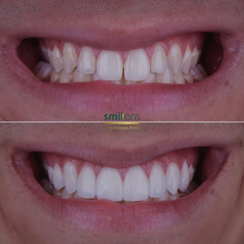 Smillens | Lentes de Contato Dental - foto 2