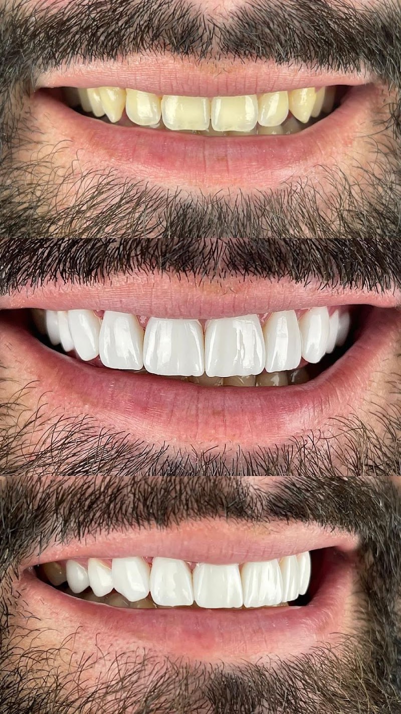 Clinica Dr Felipe Araujo - Faceta de Resina em Barra da Tijuca - Lente de Contato Dental - Lentes de Porcelana