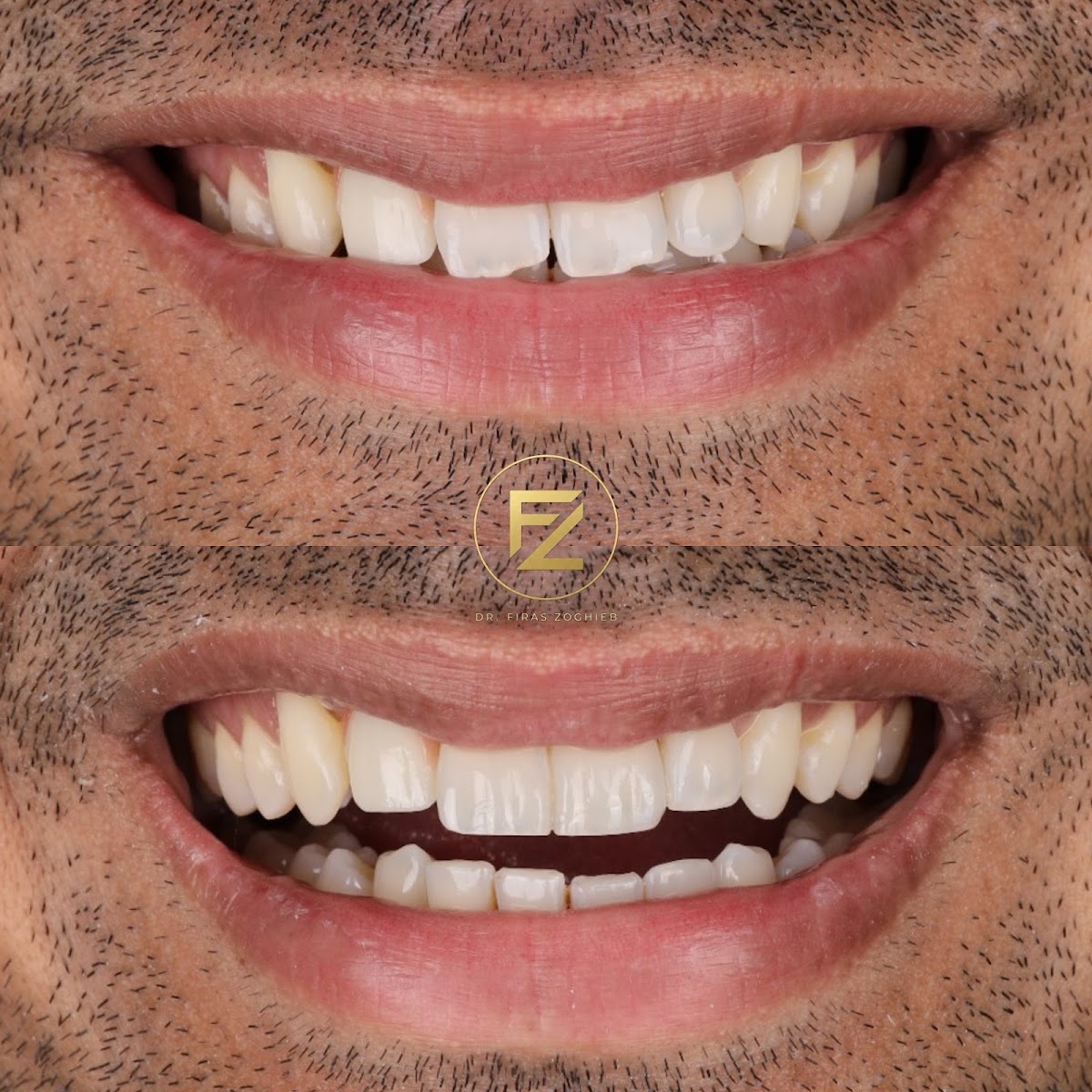 Dr. Firas | Composite Bonding - Dubai 3