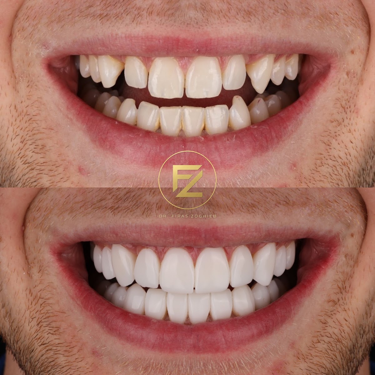 Dr. Firas | Composite Bonding - Dubai 2