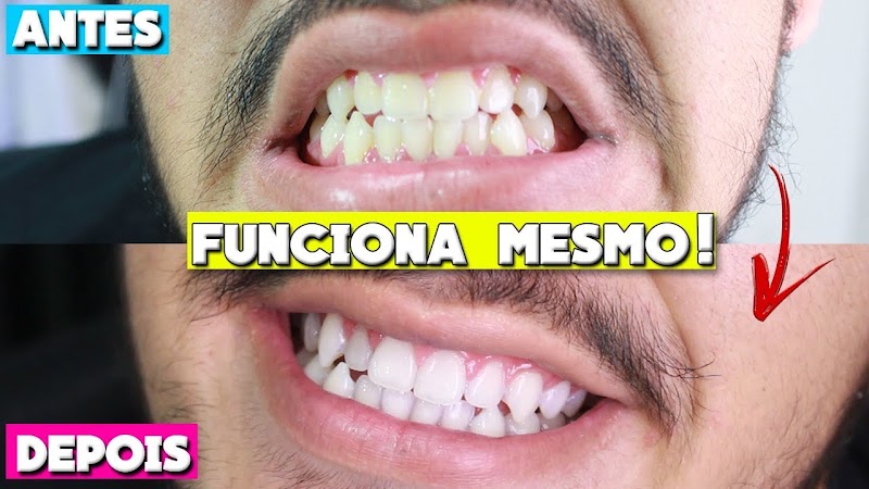 Clareamento Dental - foto 2