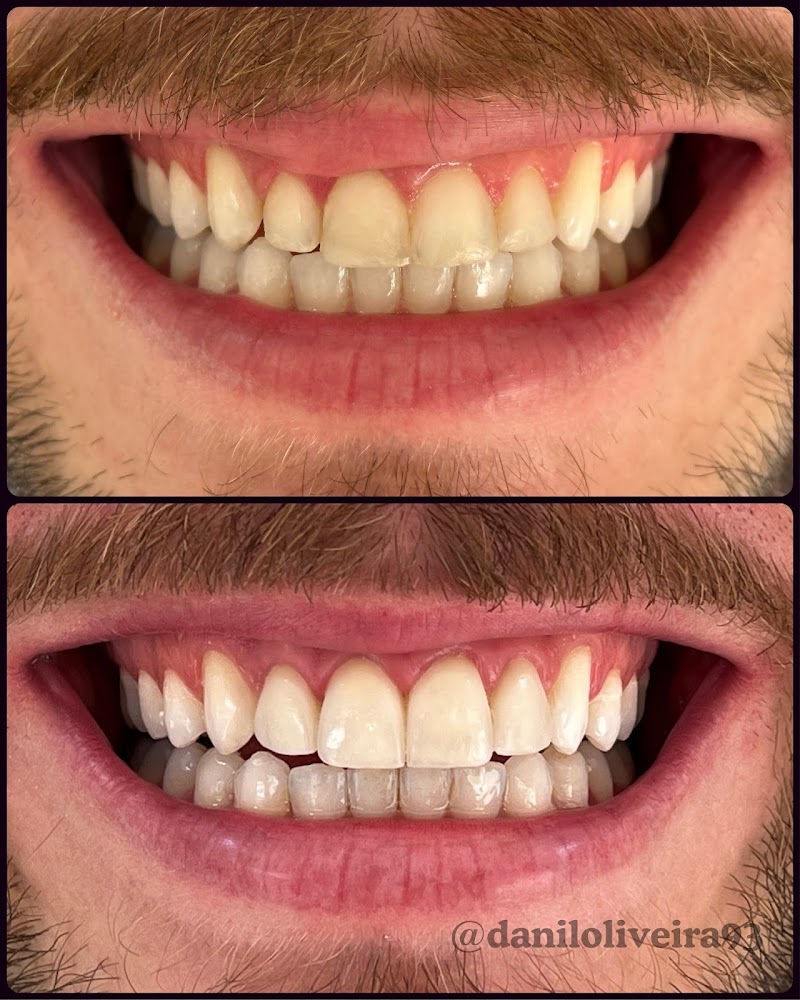 Abilità Clínica Odontológica - Lago Norte | Ortodontia em Brasília | Alinhadores Invisíveis em Brasília - foto 3